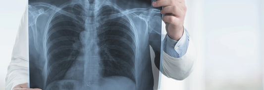 The specific effect of oxygen concentrator on pulmonary fibrosis